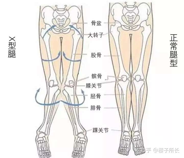 杨幂髋内旋还蛮明显的,走路时膝盖和脚都在向内转.