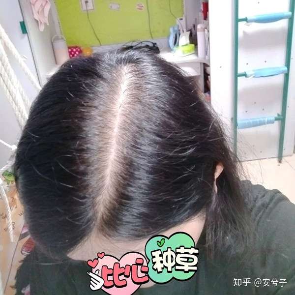 大一女生头顶秃怎么办?