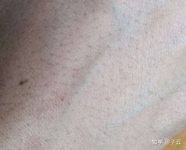 其实我并不懂什么是朱砂痣 手上的小红点我也有一个