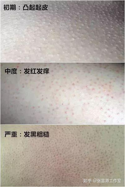 如何解决大腿脂肪硬和毛囊角化问题