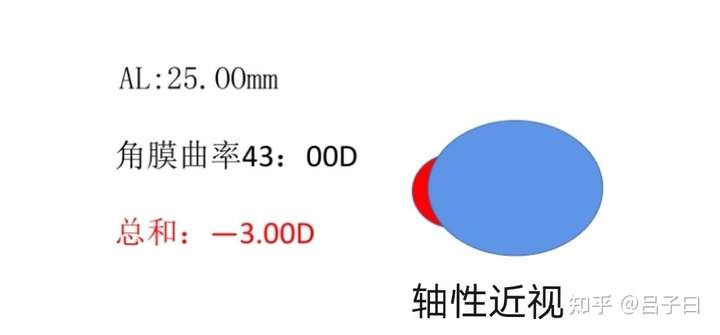 度数的影响因素除了眼轴长,还有角膜曲率,所以近视分为轴性近视和