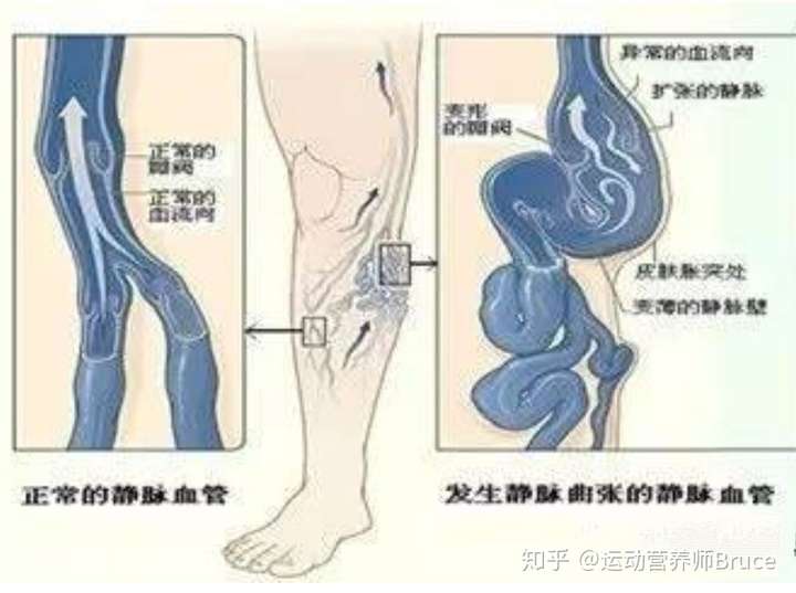 发生在胃底部,就是胃底静脉曲张-一般见于肝硬化