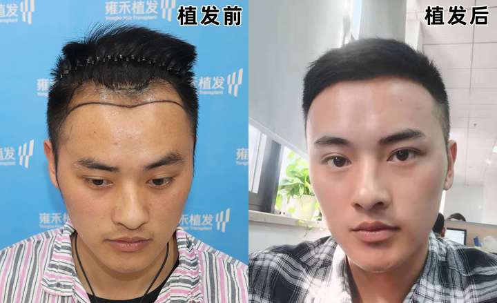 发际线太高,植发可行吗?