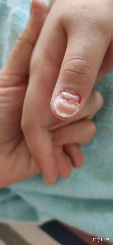 哺乳期被传染灰指甲 说一下我哈,我是七八岁得了灰指甲,是由外伤感染