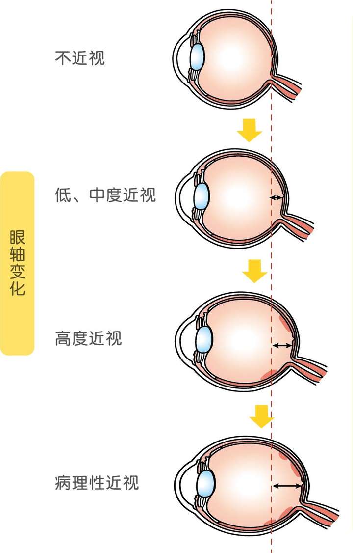 绝大部分高度近视都是由于眼轴过长导致的.
