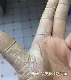 鹅掌风: 鹅掌风又被称为手气及手癣.