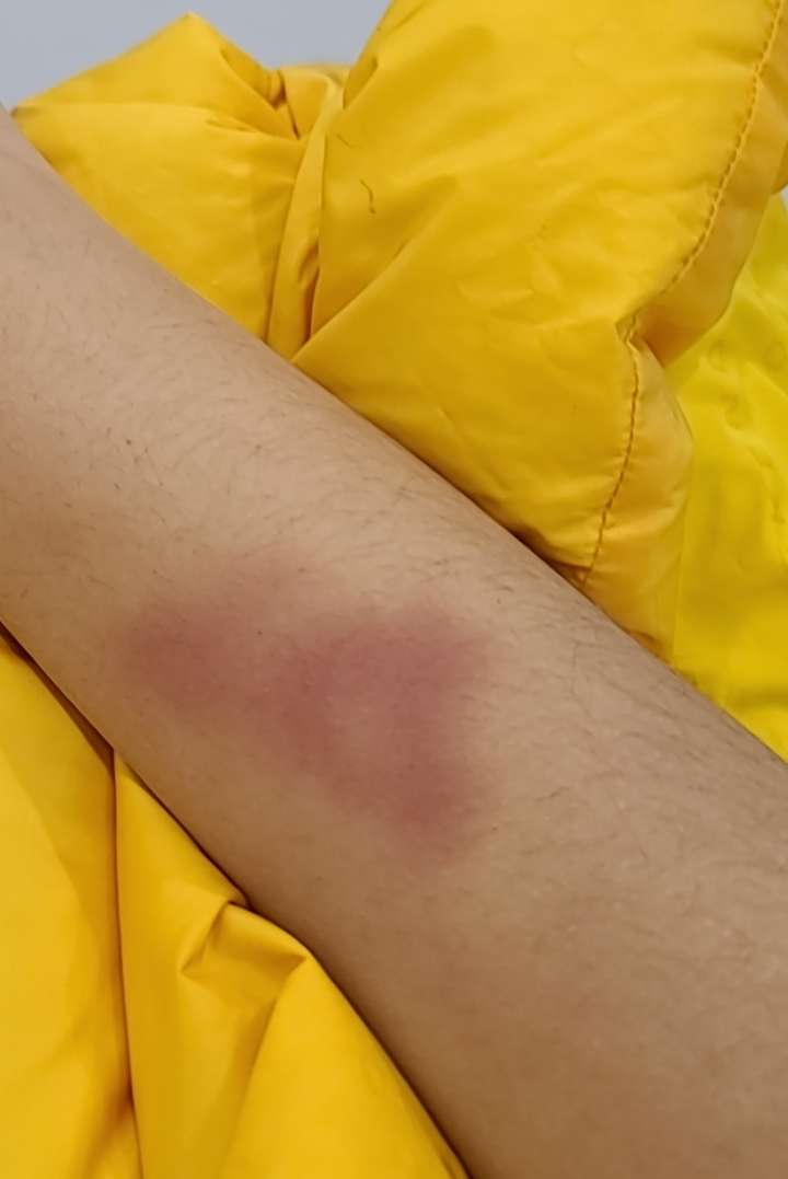 附一张刚开始打排球的时候打歪了手上的淤青