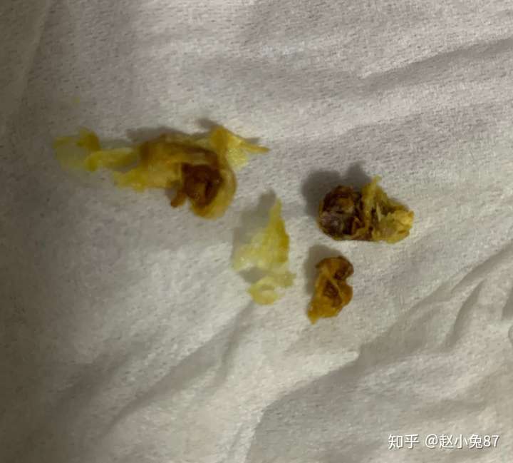 耳屎能大到什么程度?