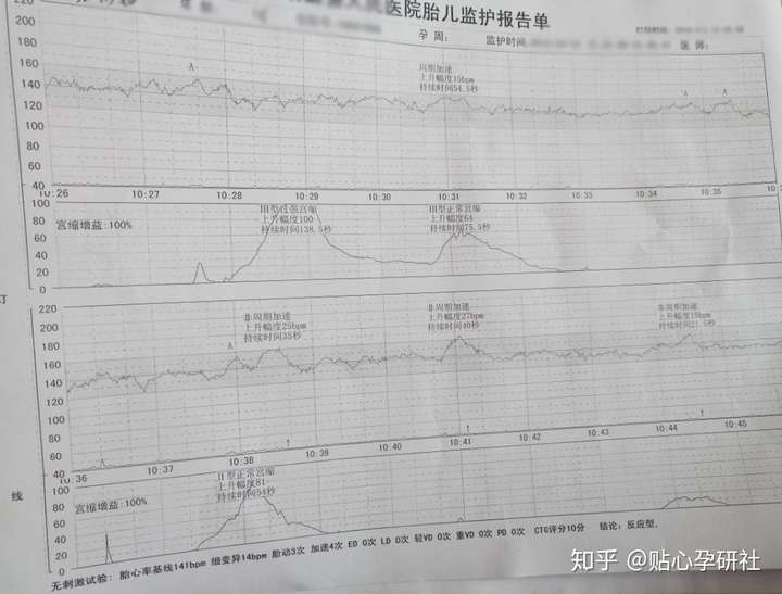 临床上胎心基线超过160次/分,持续大于等于10分钟称为胎儿心动过速.