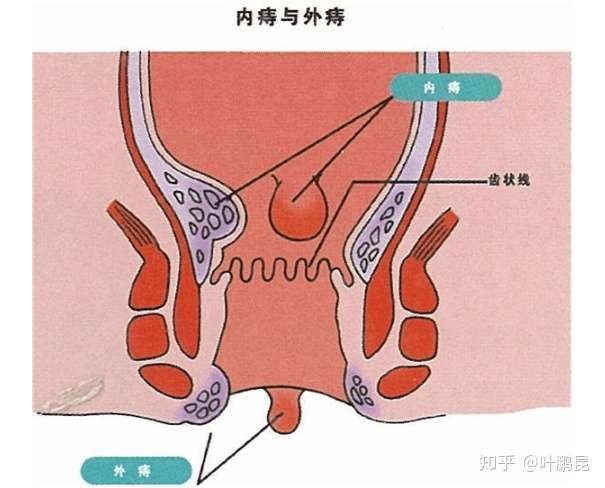 人为什么会得痔疮?