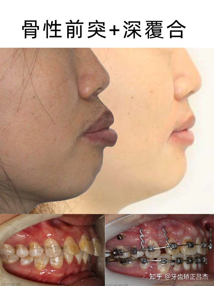 上前牙骨���薄(视频中有特写),正畸过程中容易导致骨开窗,但是我们使用