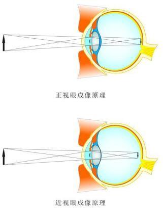 4 正常眼轴与眼轴变长后的成像原理示意