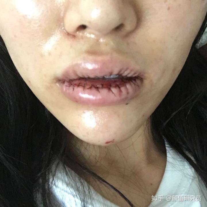 嘴唇肉多噘嘴可以吸脂解决吗?