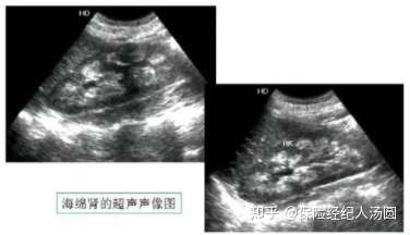 体检查出双侧髓质海绵肾,我还能买到保险吗?(附真实成功投保实例)