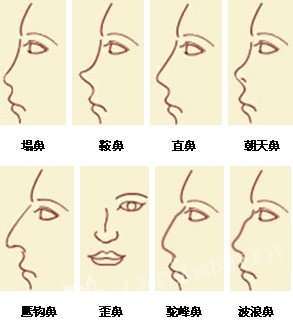 波浪鼻是驼峰鼻吗?