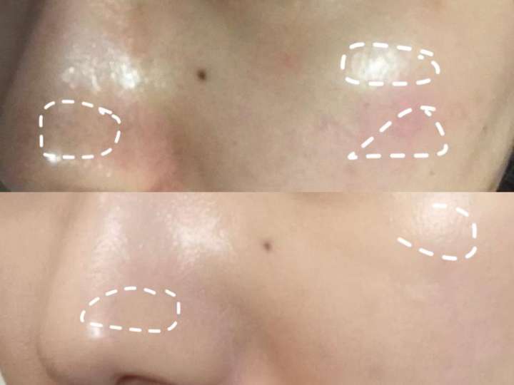 要知道怎么去除闭口,首先得知道闭口粉刺是个啥,闭口其实就是种 闭合