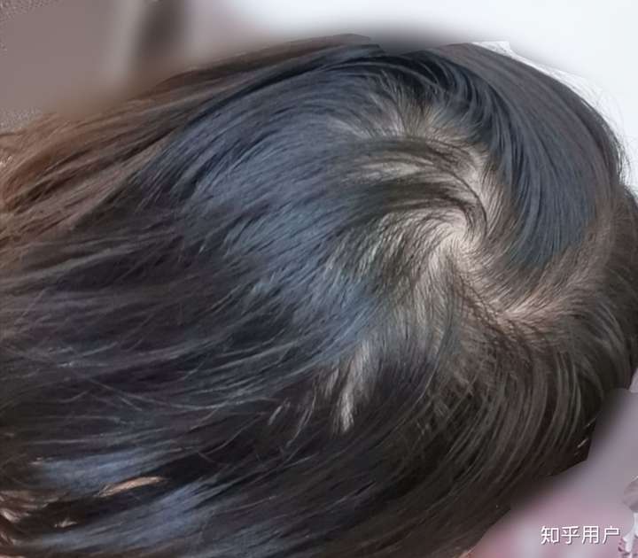 女生头顶头发少是什么体验 ?