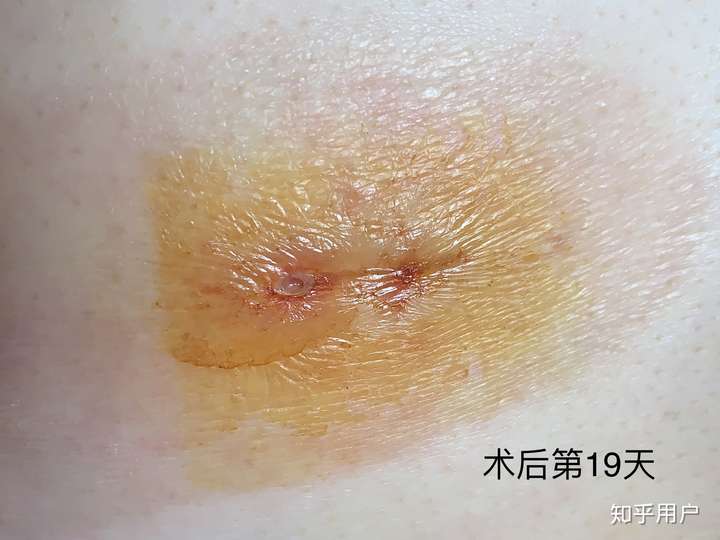 有没有女孩子得过乳腺纤维瘤啊?