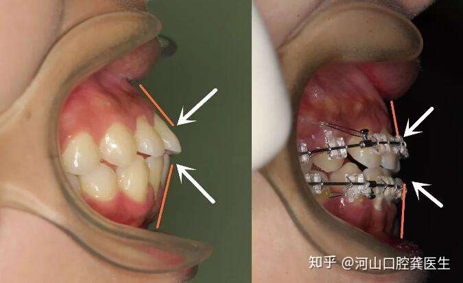 说再多都没用,我们看两个照片,对比一下拔牙矫正前后: 一,下牙拥挤