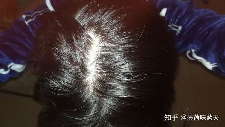 大家用「米诺地尔」真的有生发效果吗?
