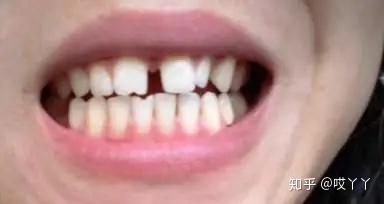 【西安圣贝口腔科普】牙缝大,说话漏风,不做牙齿矫正还有别的办法吗?