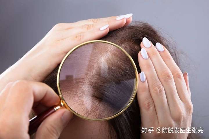 如何改善女性脱发得用什么产品