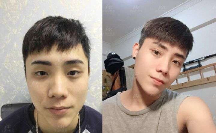 男生做双眼皮手术是什么体验