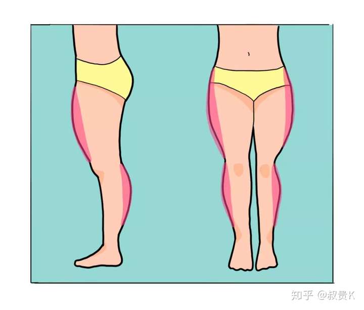 大腿外侧突出型