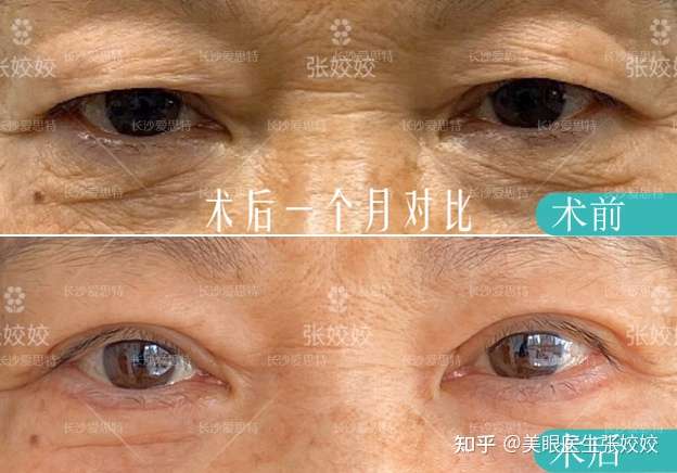 眼周皮肤松弛双眼皮变单眼皮了怎么办?