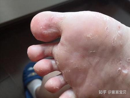 脚气是真菌感染引起的脚部皮肤病,分为水泡型脚气,糜烂型脚气和鳞屑