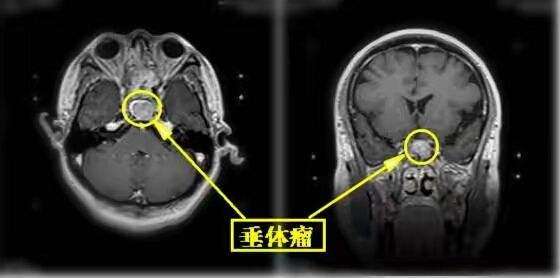 垂体负责人的什么功能为什么垂体瘤患者易发失明