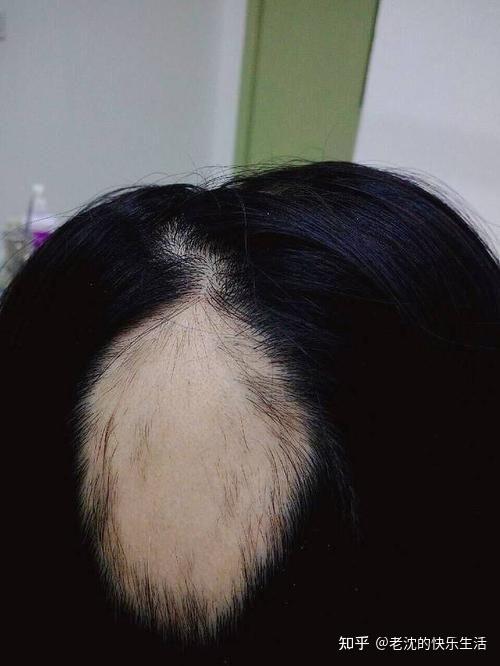 二,药物性脱发:比如化疗性药物会导致大量的头发脱落.