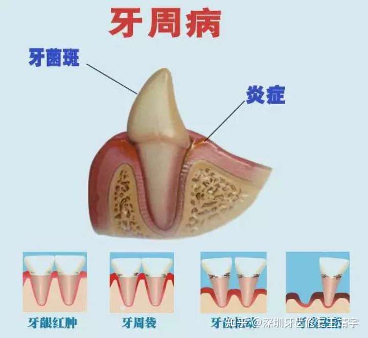 牙周炎是一种口腔常见病,表现为牙龈红肿,出血,萎缩,牙槽骨退缩,牙齿