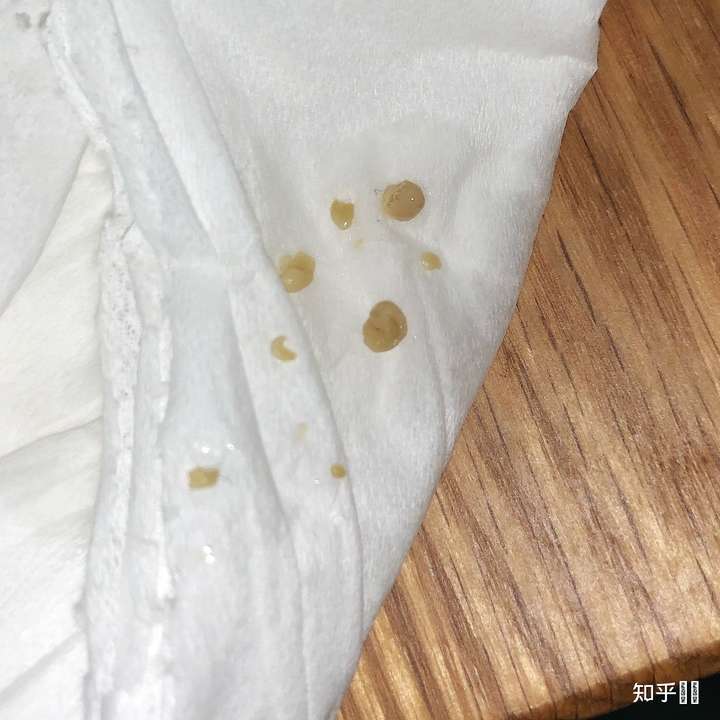扁桃体结石如果不人为清除,它自己会脱落吗?
