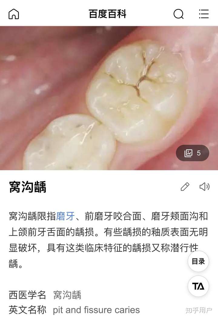 专业名称:窝沟龋!