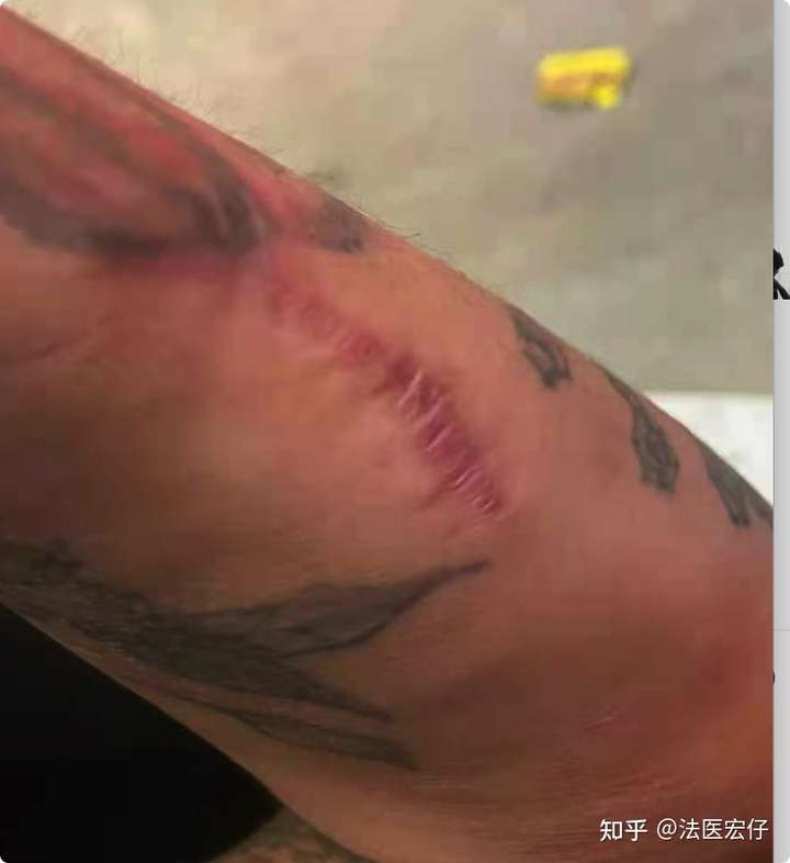 5cm的情况,或者其他临界轻伤标准) 对于比较临界的创口,我比较不赞成