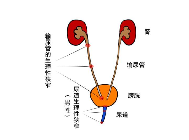 肾结石能完全排出吗?