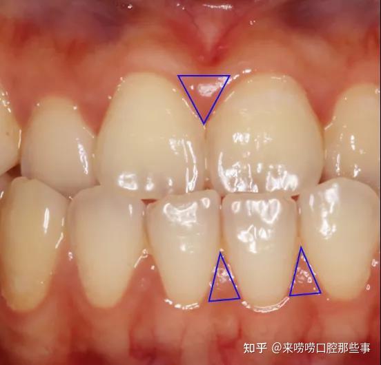 牙齿矫正产生的牙龈萎缩黑三角问题真的是不可逆的吗