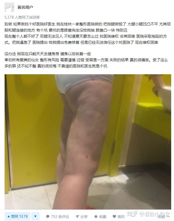 做了抽脂的人后悔了吗