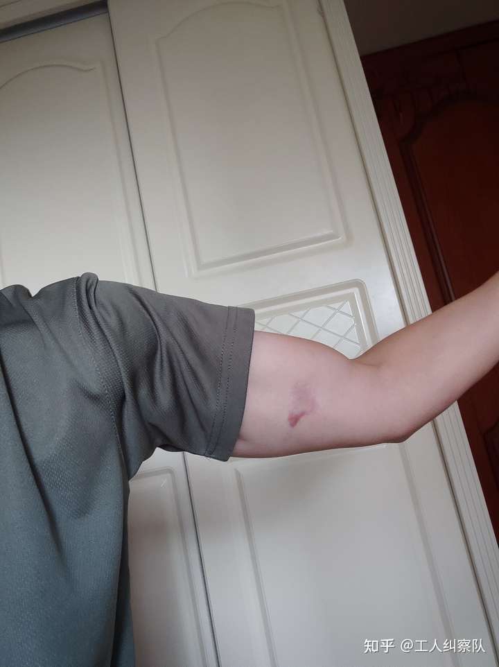 手臂内侧有三道细细的三厘米长的疤(伤口很浅)可以考警校吗?