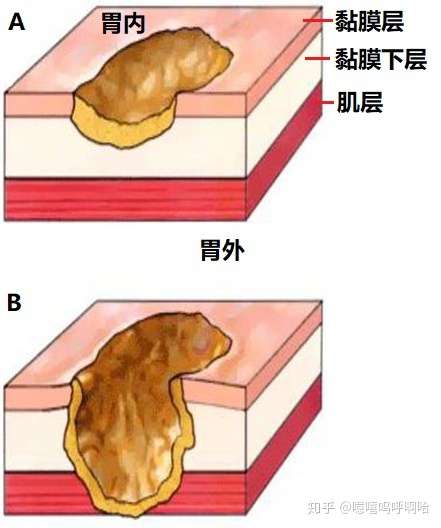 胃壁的结构可以简单分为4层:从内到外依次为黏膜层,黏膜下层,肌层和