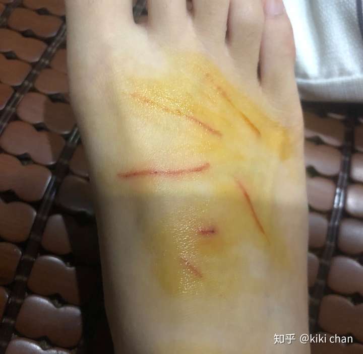 被猫抓流血了怎么办.