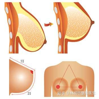 乳房下垂如何改善科普胸部提升手术