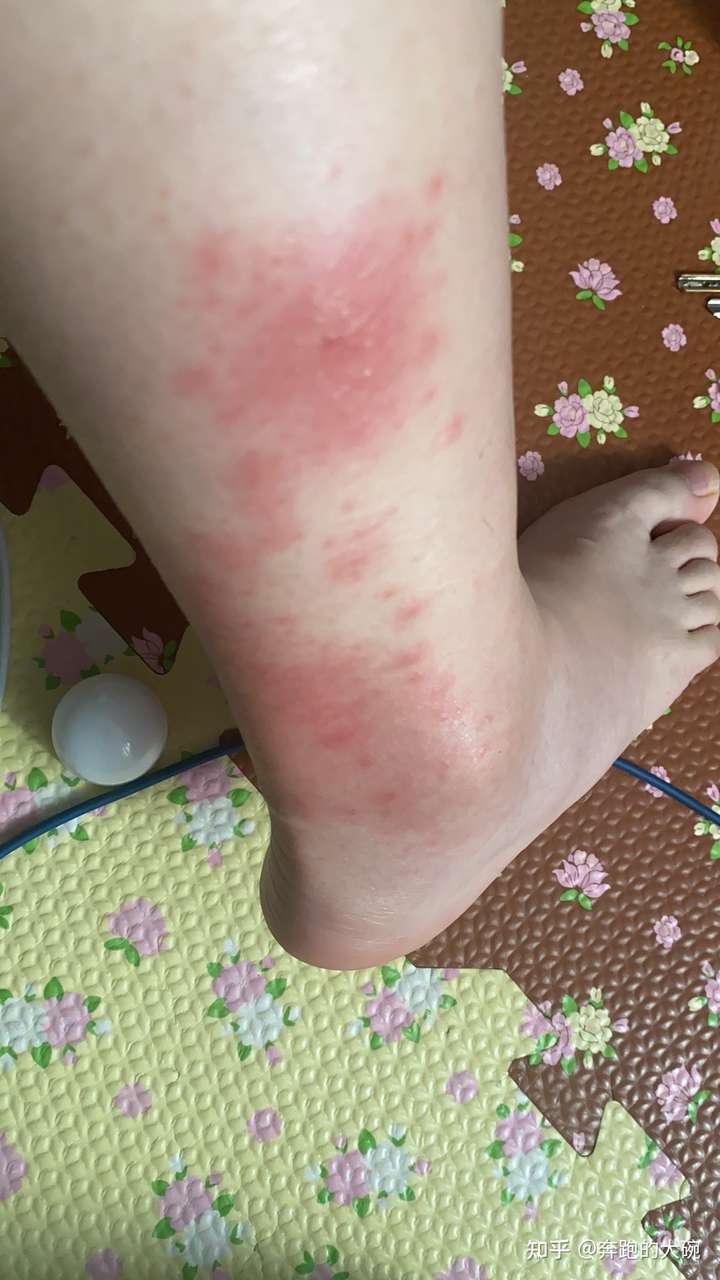 我不知道被什么虫子咬了脚踝很痒出现了红色的肿块中间还有个透明凸起