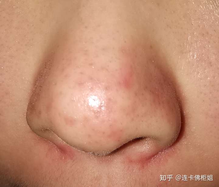 之前挤黑头把鼻子挤出好多洞特别是图上那个超级大 今天实在受不了就