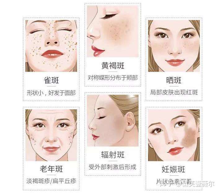 脸上的色斑,怎么去除?安全,效果好?