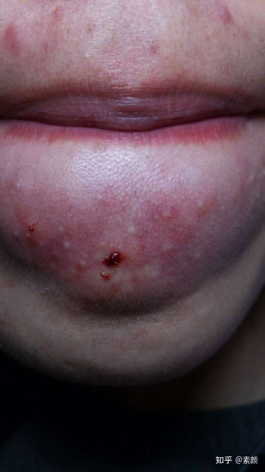 下巴和嘴巴附近区域常年长囊肿型痘痘(消了又长,长了又消),有什么可以