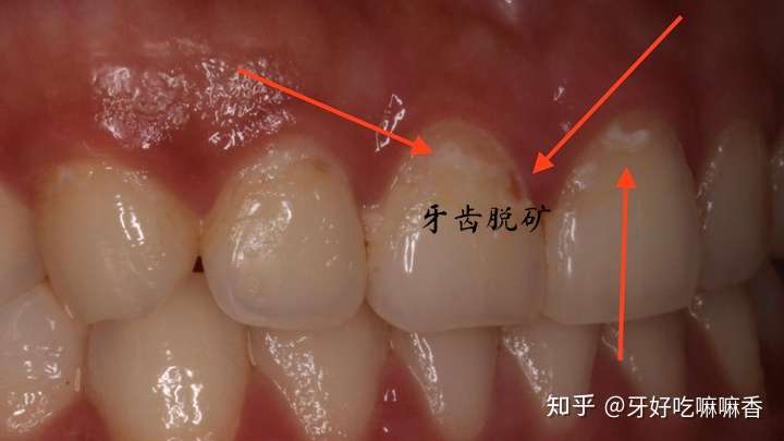 正畸真的会导致牙齿脱矿吗?这5点预防方式学起来
