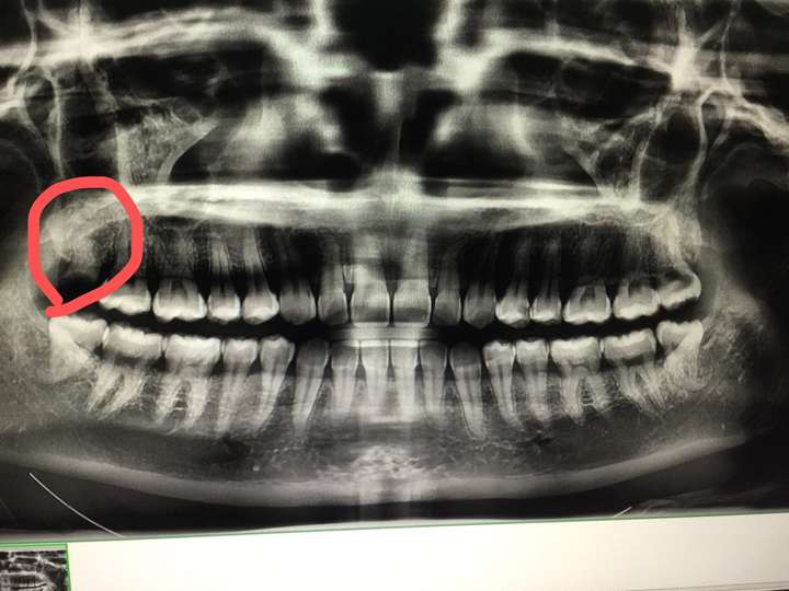 右上角的智齿被蛀牙吃得只剩牙根了