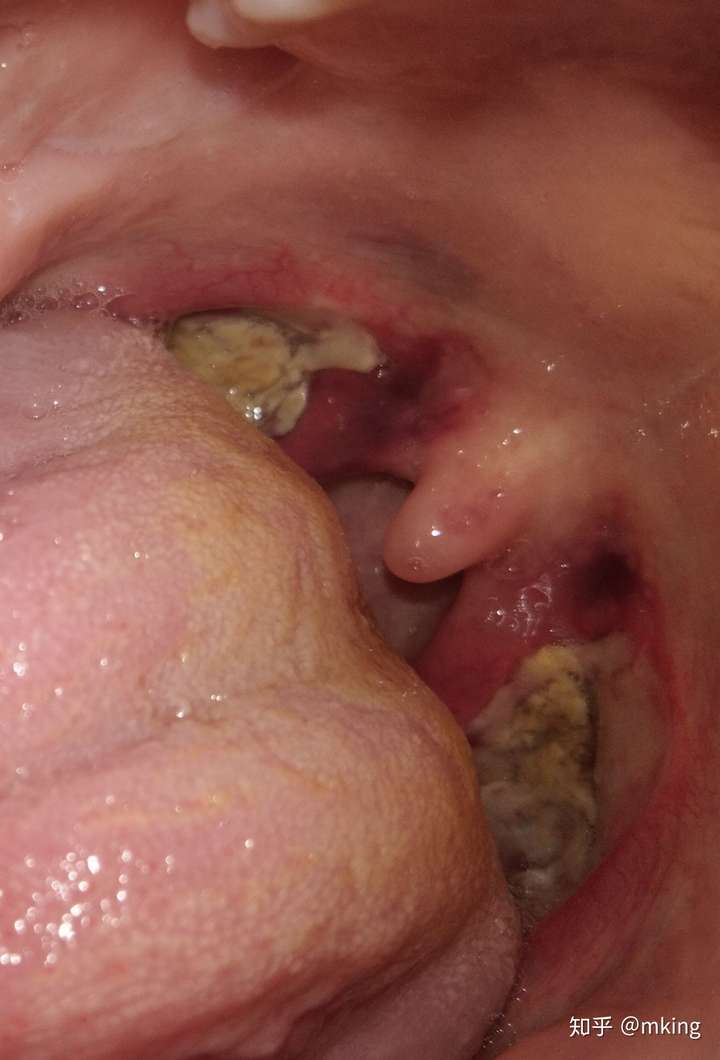 切扁桃体之后是什么感觉?